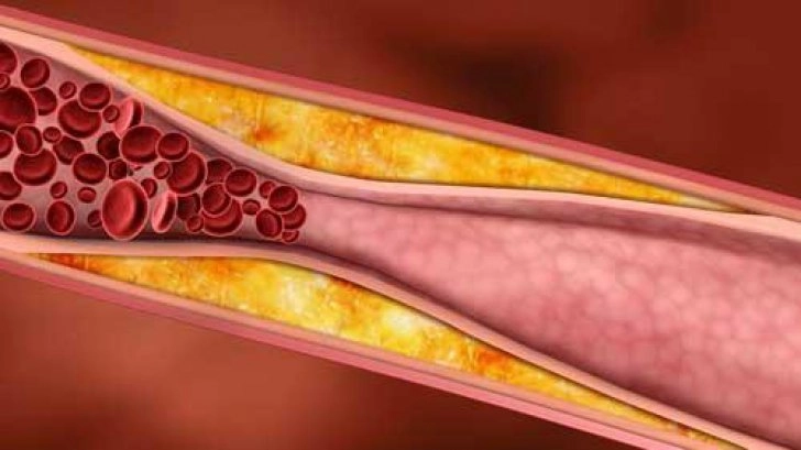 Cum afectează problemele tiroidiene nivelul colesterolului