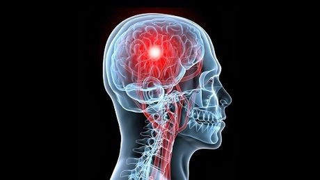 Un dispozitiv cu AI ajută pacienţii cu AVC să comunice din nou fluent