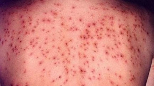 OMS trage alarma: Rujeola revine puternic în Europa