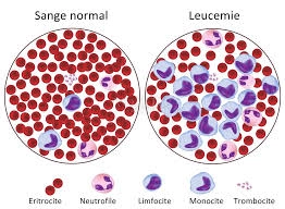Un nou studiu sugerează că mulți pacienți cu B-ALL pot renunța la iradierea totală înainte de transplant