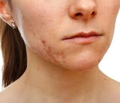 Premieră în România – unde se află singurul aparat laser de ultimă generație care tratează acneea