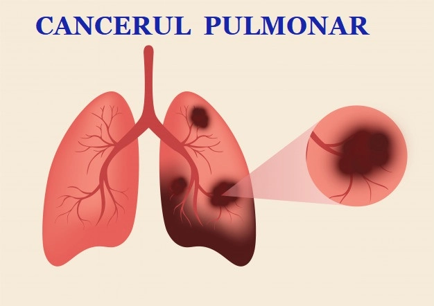 Zongertinib arată rezultate promițătoare în tratarea cancerului pulmonar avansat