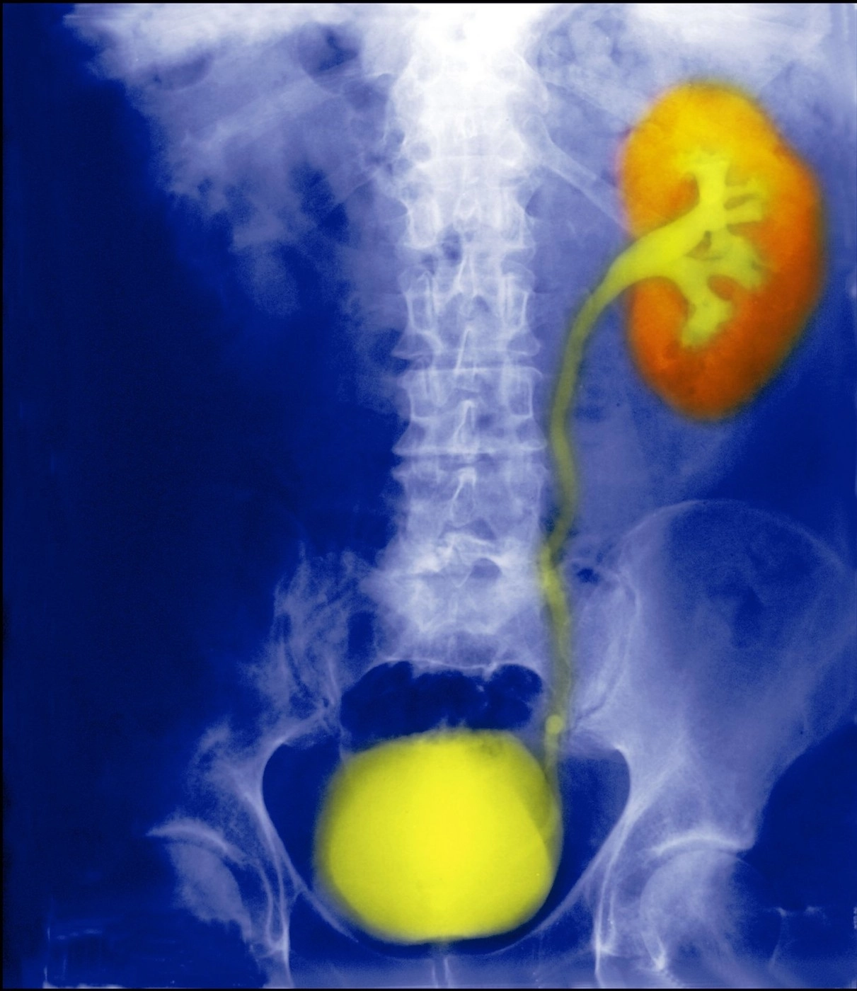 Daltonismul ar putea ascunde un semn timpuriu al cancerului de vezică urinară