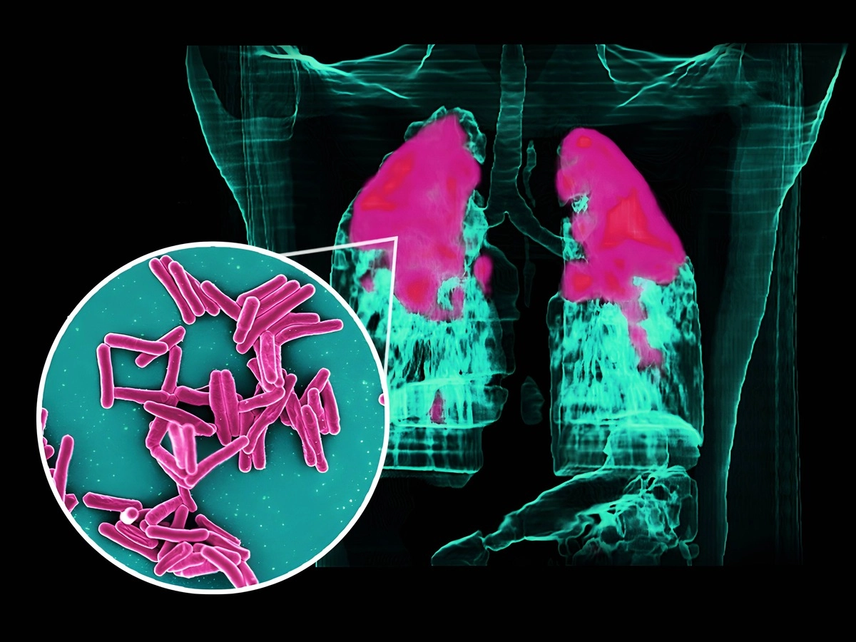 Speranță pentru milioane de pacienti: un nou compus promite să învingă tuberculoza