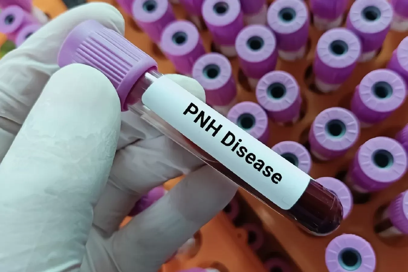 Ziua Mondială de Conștientizare a Hemoglobinuriei Paroxistice Nocturne în România