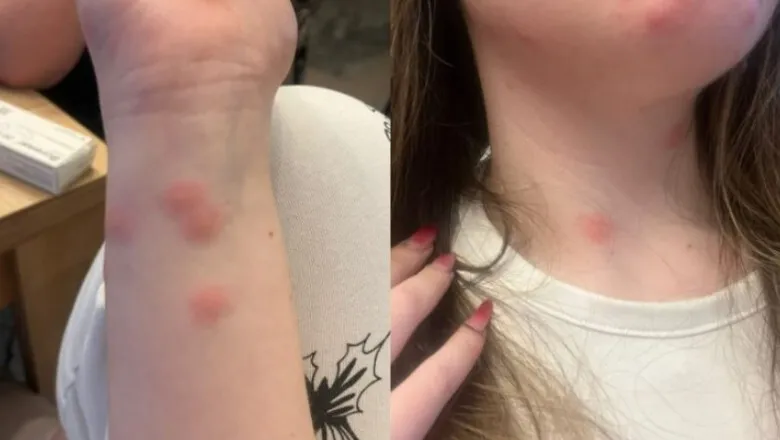 Călătorie de groază: O tânără a ajuns la spital după ce a fost mușcată de ploșnițe într-un tren CFR