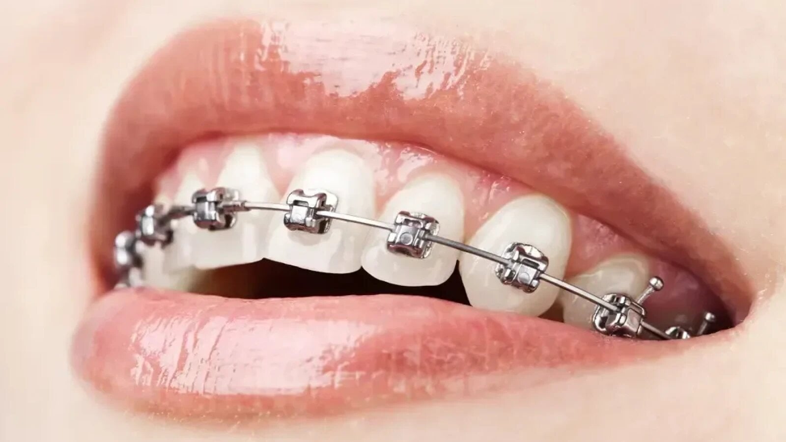 Ce trebuie să știi dacă urmează să porți un aparat dentar invizibil pentru adulți